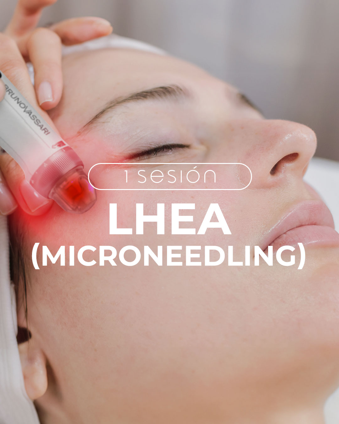 1 sesión microneedling para arrugas, acné, flacidez
